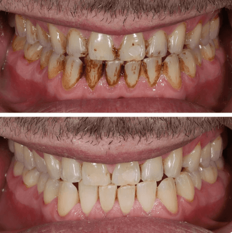 Diş Köprüsü - Öncesi ve Sonrası - DentNora
