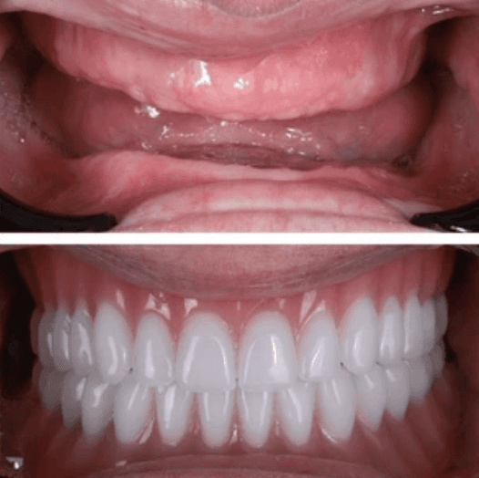 Tam Protez - Öncesi ve Sonrası - DentNora