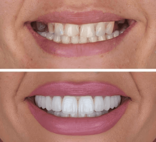 Tam Ağız Restorasyonu - Öncesi ve Sonrası - DentNora