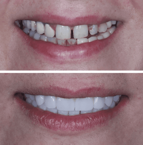 Diş Kaplama - Öncesi ve Sonrası - DentNora