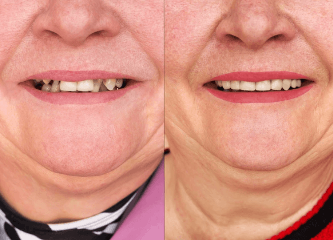 Lamina Kaplama - Öncesi ve Sonrası - DentNora