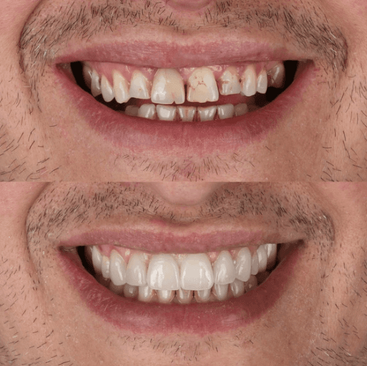 Hollywood Gülüşü - Öncesi ve Sonrası - DentNora