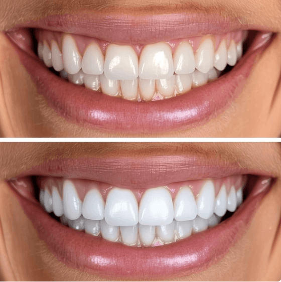 Diş Beyazlatma - Öncesi ve Sonrası - DentNora